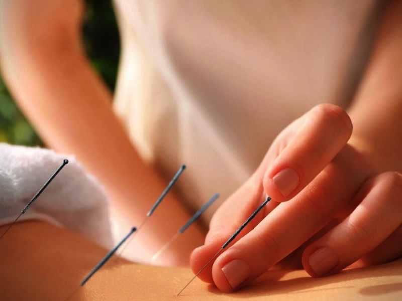 Acupuntura
